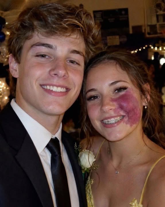 Only One Boy Asked Me to Prom Because No One Else Wanted To Due to the Birthmark on My Face – Everyone Laughed Until a Police Officer Walked Into the Ballroom