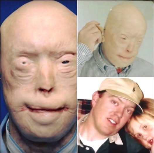 Firefighter Endured Devastating Burns—This Is Where His Life Stood 11 Years Later
